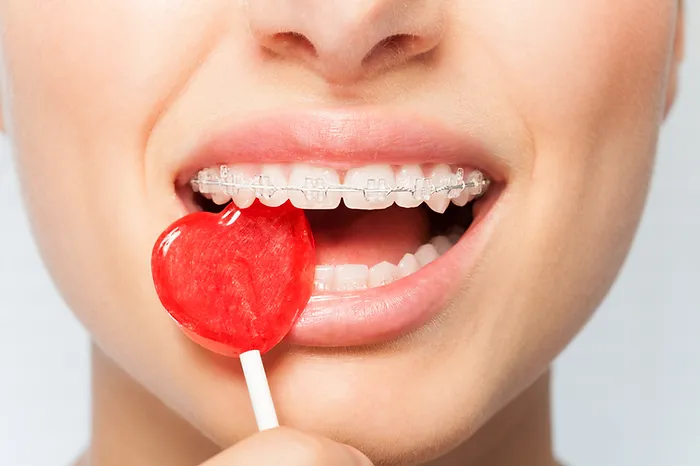 – FOODS TO AVOID WHILE WEARING BRACES